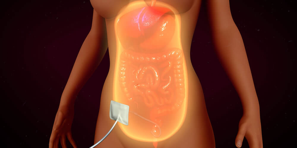 Cateter de Diálise Peritoneal